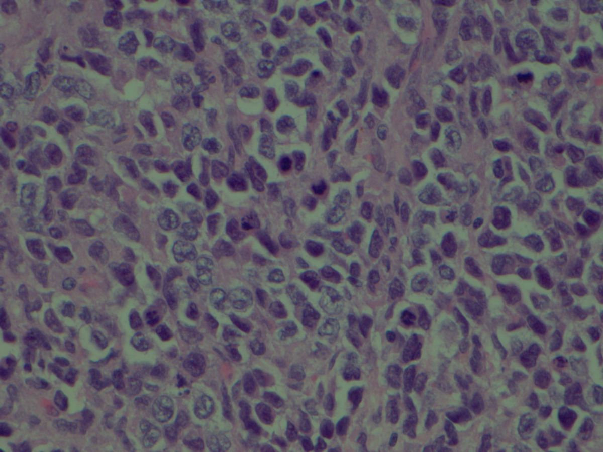 Left ankle with myeloid sarcoma (H&E  X400)